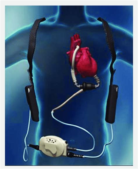 Schematic representation of HeartMate II continuous-flow left ...