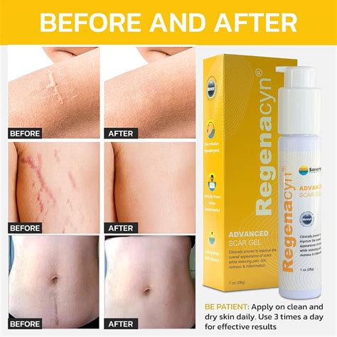 Regenacyn Scar Gel Advanced Acne Scar Treatment With Hypochlorous Acid