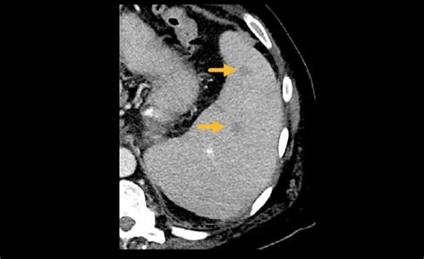 Abdominal Ct Spleen And Adrenal Glands • Litfl • Radiology