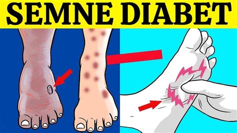 7 SEMNE NOCTURNE ALE DIABETULUI ZAHARAT PE CARE NU TREBUIE SĂ LE IGNORI