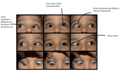 Special Forms Of Strabismus Flashcards Quizlet