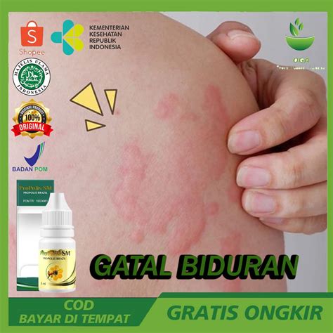 Jual Obat Biduren Herbal Obat Gatal Bekas Biduran Alergi Penyakti