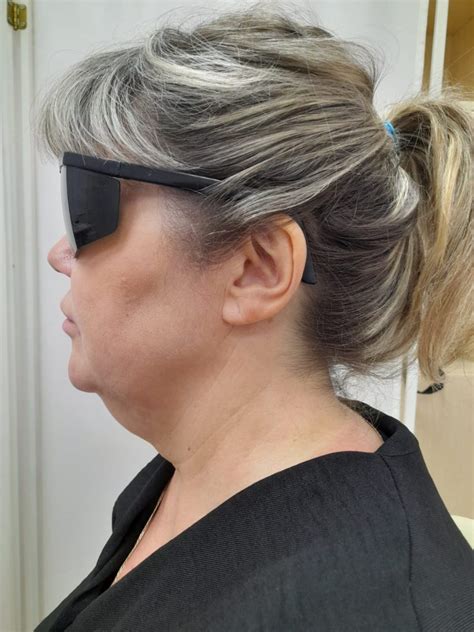 ЛАЗЕРНАЯ ЛИПОСАКЦИЯ ⋆ ЦЕНТР ЛАЗЕРНОЙ МЕДИЦИНЫ