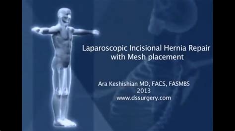 Laparoscopic Incisional Hernia Repair With Mesh Placement Youtube