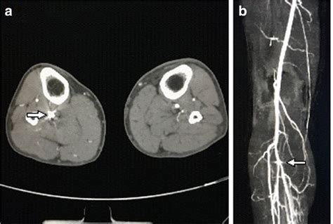 Successful Surgical Retrieval Of Celt Acd Vascular Closure Device