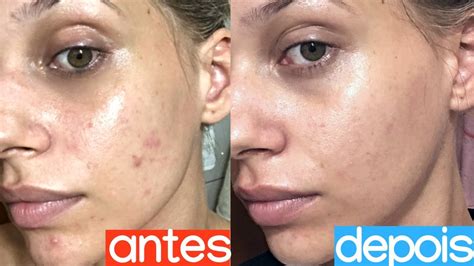 COMO TRATAR AS MANCHAS DE ACNE EM CASA YouTube