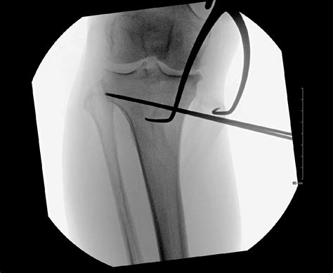 Open Wedge High Tibial Osteotomy To Repair Bowed Legs Varus Deformity