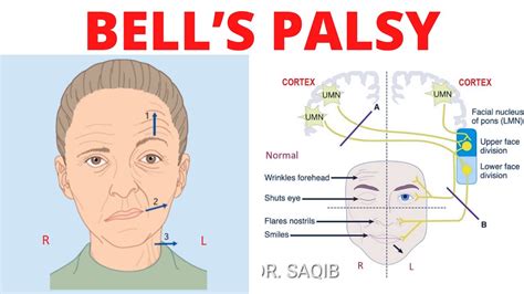 Bells Palsy Causes Symptoms Diagnosis Treatment Youtube