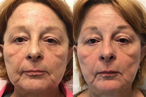 Chemical Peels Photo Gallery Contour Dermatology