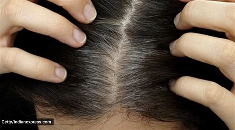 Know The Causes Of Premature Greying Of Hair And Ways To Deal With It