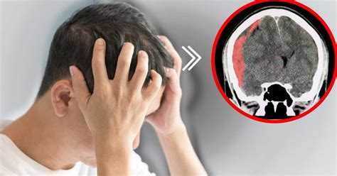 Hematoma Intracranela Qué Es Y Cuáles Son Sus Riesgos Salud180