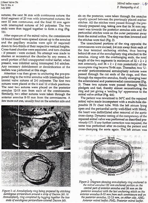 Diagram showing annuloplasty ring anchored the mitral unmdus (32 mm ...