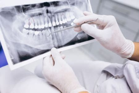 Radiografia Odontol Gica Quais S O Os Tipos E Como Funciona O Exame