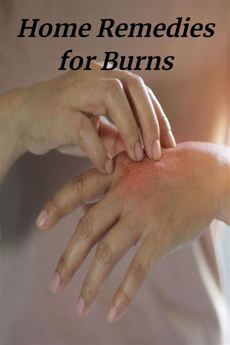 Home Remedies For Burns Home Remedies For Burns How To Heal Burns Eczema Cure