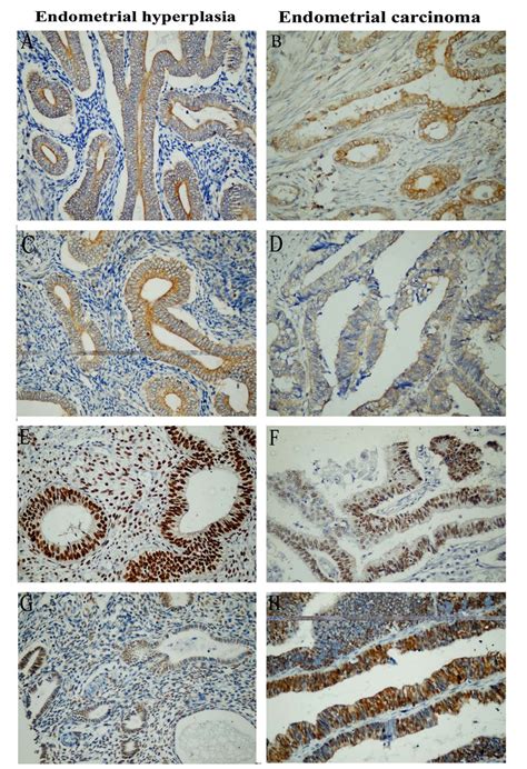 Expression Of Bcl2 Bax ER And PR In Endometrial Lesions