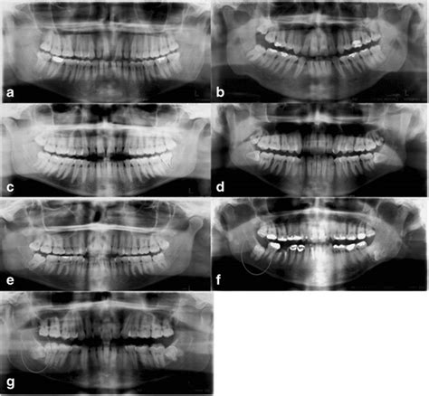 Classification Of Roots Type A Simple B Hypercementosis C Thin D