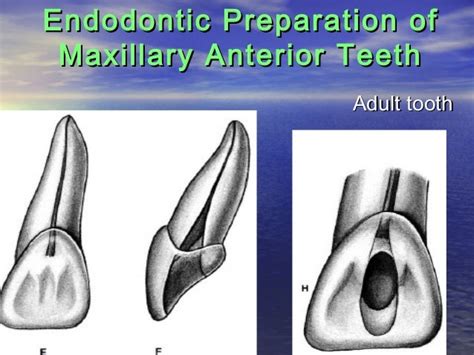 Access Cavity Preparation