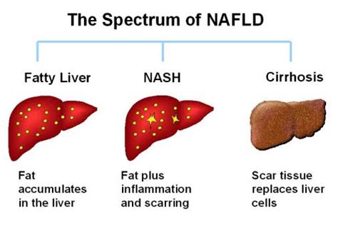 Non Alcoholic Fatty Liver Disease Causes Symptoms Diagnosis