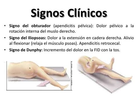 Apendicitis