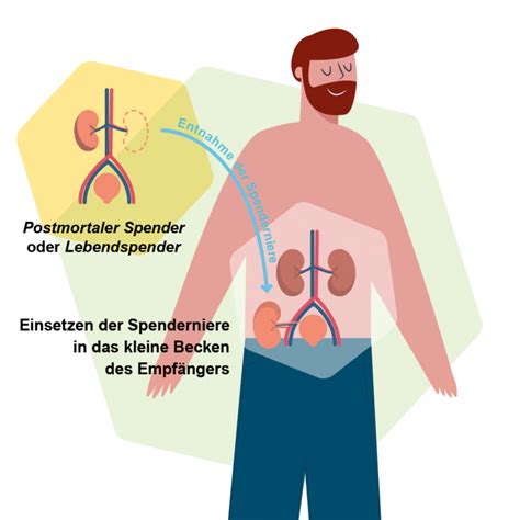 Ablauf Einer Organtransplantation Von Der Diagnose Bis Zur Op