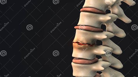 Disc Degeneration With Osteophyte Formation In The Human Spine Stock