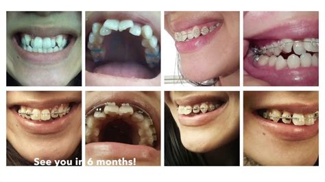 Adult Braces Time Lapse 6 Months Youtube