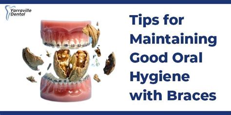 Tips For Maintaining Good Oral Hygiene With Braces Yarraville Dental