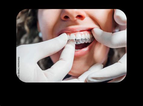 Everything You Need To Know About Invisalign Orthoed Orthotraining