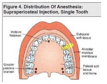 Local Anesthesia Injections Flashcards Quizlet