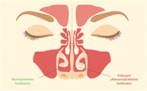 All You Need To Know About “sensitive Nose” Rhinitis Dr Gan Eng Cern