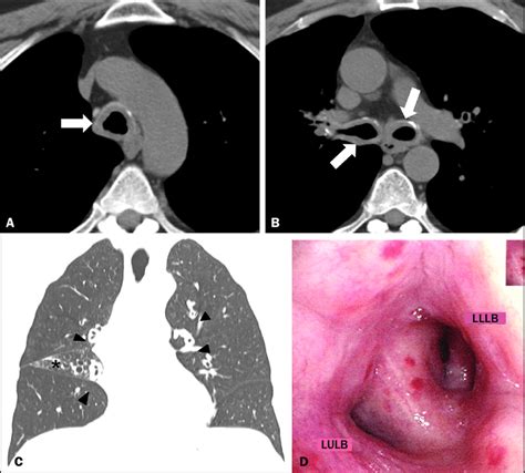 A B Axial Ct Scan Of The Chest Mediastinal Window Without Contrast