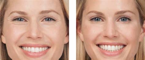 Botox For Facial Paralysis Before And After