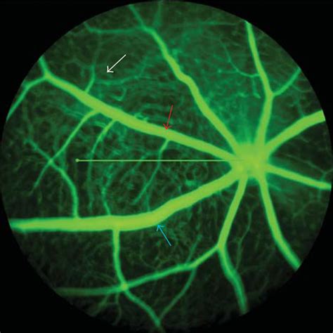 Fluorescein Angiogram And Corresponding Spectral Domain Optical