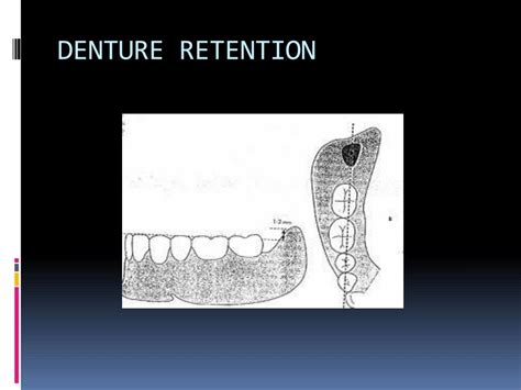 Ppt Dsp 332 Principles Of Complete Denture Prosthodontics Powerpoint