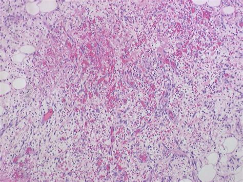 Hematoxylin And Eosin Staining Of Colonic Biopsy Specimen Showing Acute Download Scientific