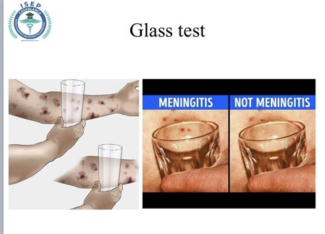 Abdu BOUAGGAD On Twitter Glass Test In Favor Of Meningitis