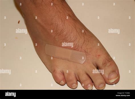 Injured Foot With Bleeding Abrasion Wound Isolated On White Background