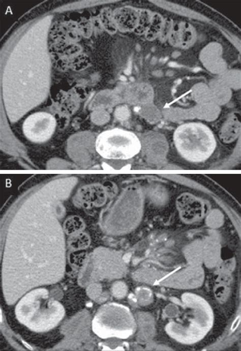 Tuberculous Lymph Node Disease In A 54 Year Old Male Patient Presence