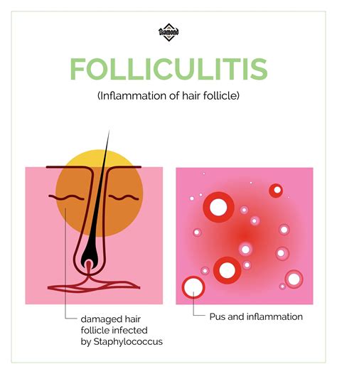 A Spotlight on Folliculitis - K9 Pie