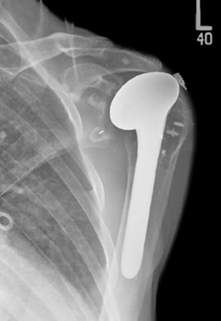 Patient Satisfactioncomplications Following Revision Of Failed Shoulder Replacement Boston