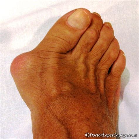 Hallux Valgus Juanete Biclinic