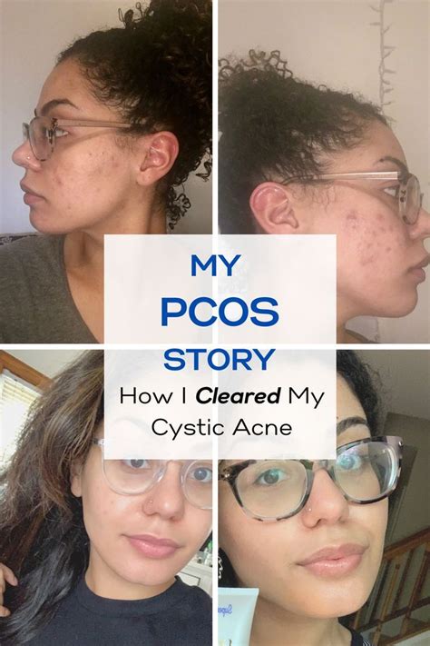 My Pcos Story Cystic Acne Treatment Cystic Acne Acne Treatment