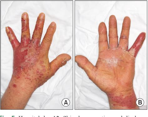 Staphylococcal Scalded Skin Syndrome In A Healthy Adult Easy To Misdiagnose Semantic Scholar