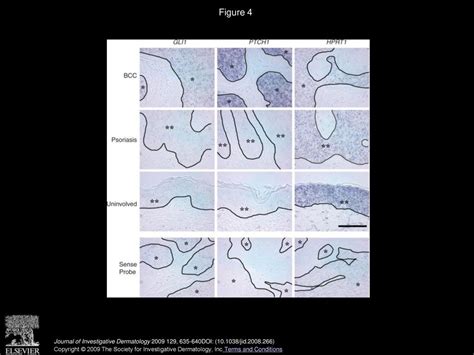 Lack Of Evidence For Activation Of The Hedgehog Pathway In Psoriasis