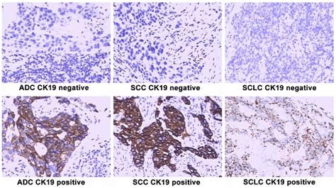 Immunohistochemical Analysis Of Tumor Marker Cytokeratin Ck