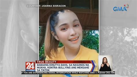 Babaeng Kinutya Dahil Sa Nasunog Na Mukha Kontra Bullying Ang Mensahe