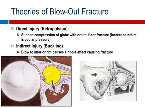 Orbital Floor Fracture Causes | Review Home Co