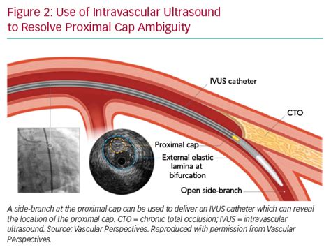 Use of Intravascular Ultrasound to Resolve Proximal Cap Ambiguity ...