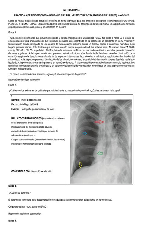 Derrame Pleural Y Neumotorax Resuelto Alejandro Sanchez Solis