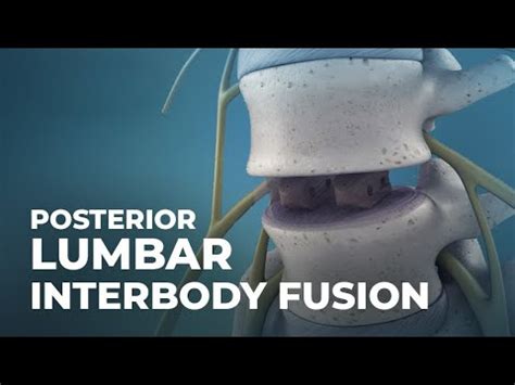 What Is Posterior Lumbar Interbody Fusion PLIF Atlantic Spine